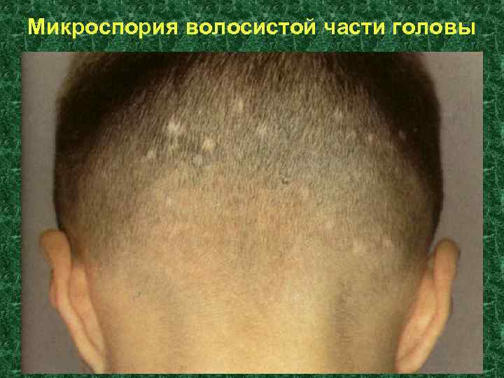 Микроспория волосистой части головы 