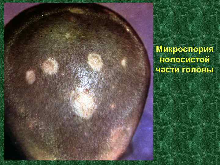 Микроспория волосистой части головы 