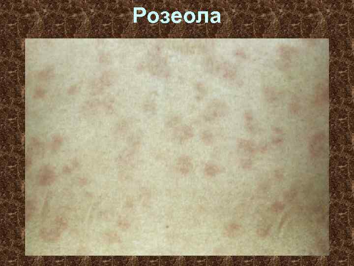 Розеола 