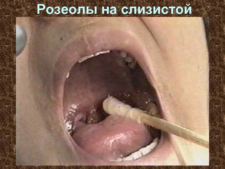 Розеолы на слизистой 