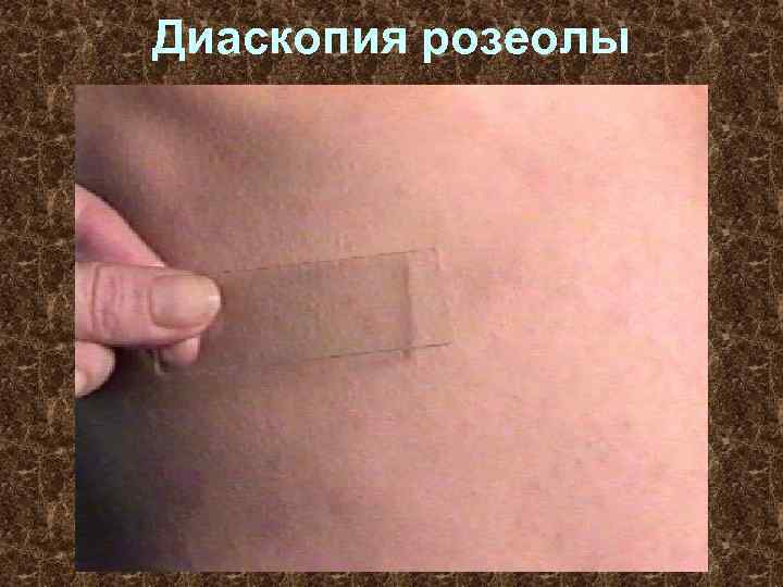 Диаскопия розеолы 