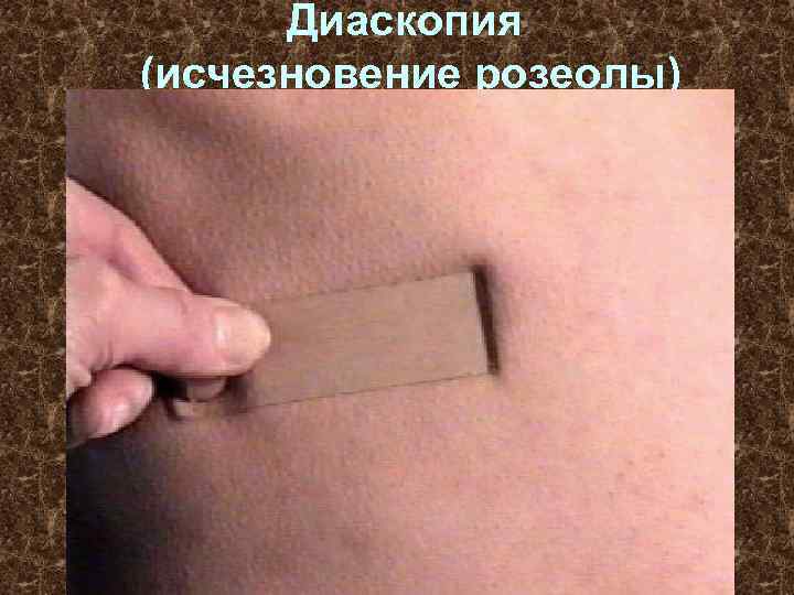 Диаскопия (исчезновение розеолы) 