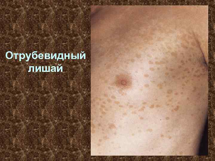 Отрубевидный лишай 