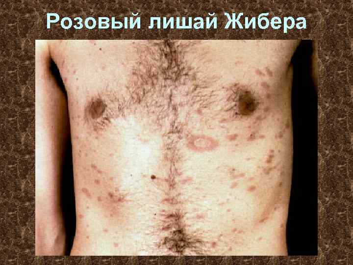 Розовый лишай Жибера 