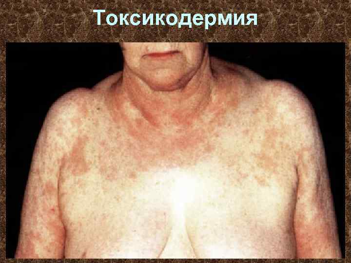 Токсикодермия 