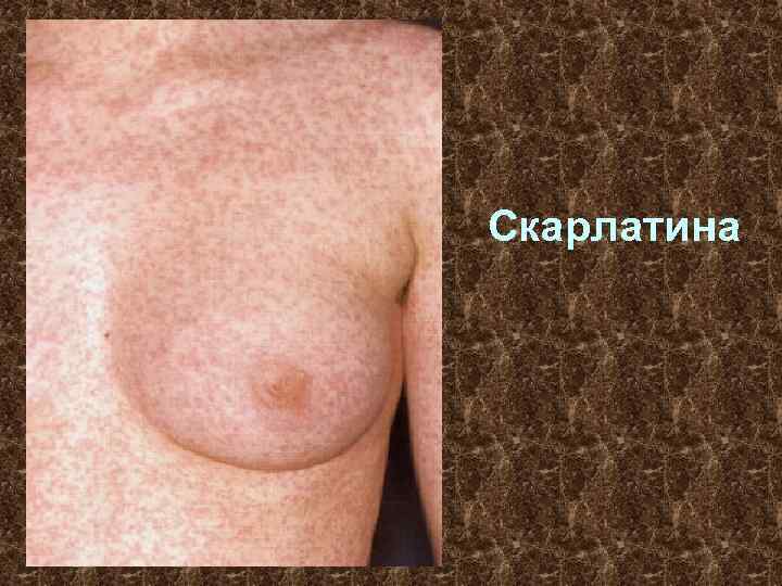 Скарлатина 