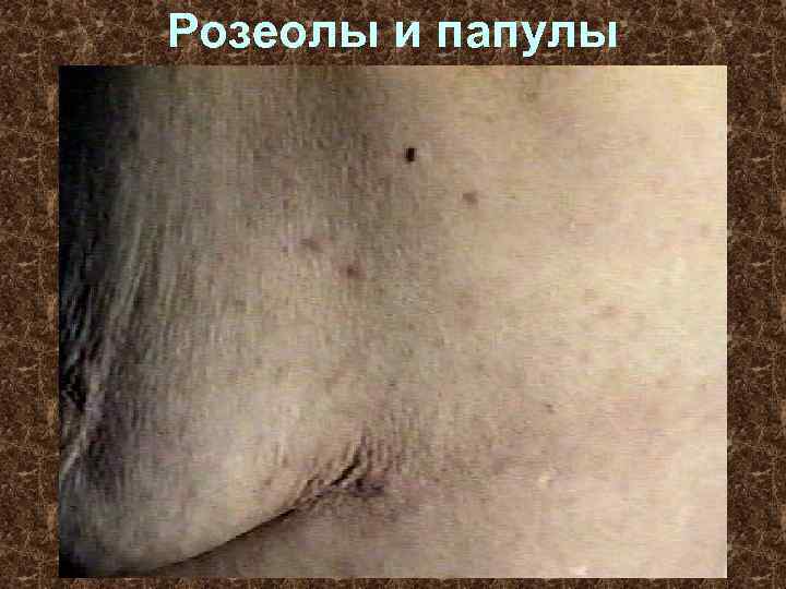 Розеолы и папулы 