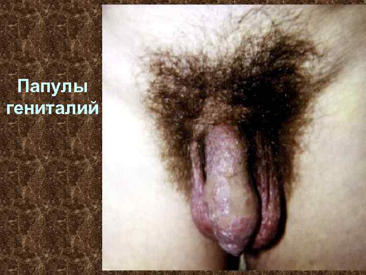 Папулы гениталий 