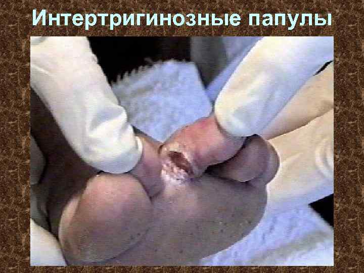 Интертригинозные папулы 
