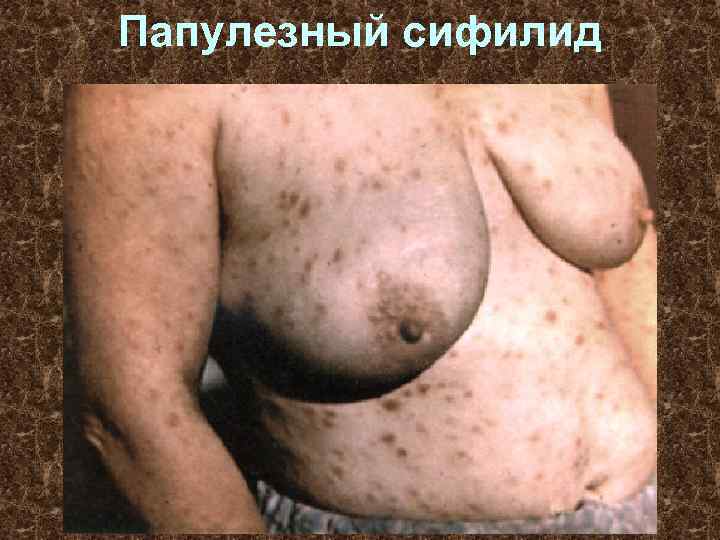 Папулезный сифилид 
