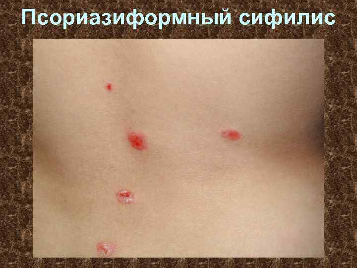 Псориазиформный сифилис 