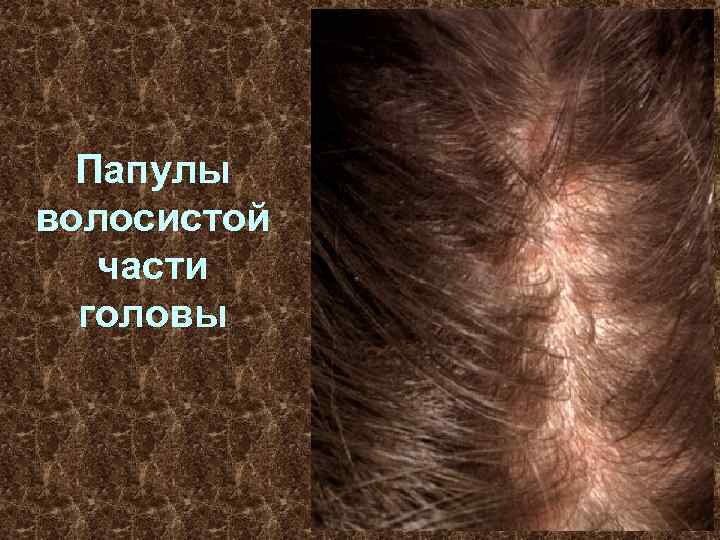 Папулы волосистой части головы 