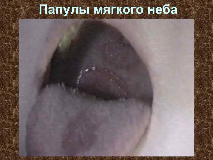 Папулы мягкого неба 