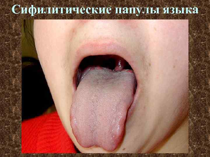 Сифилитические папулы языка 