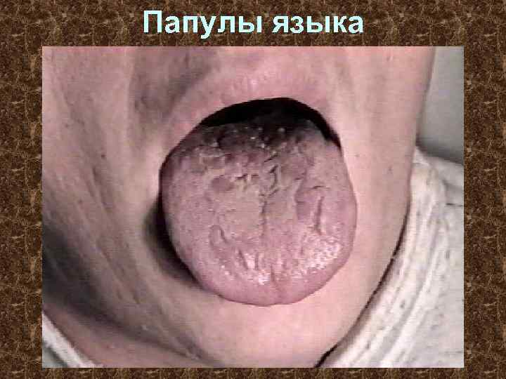 Папулы языка 