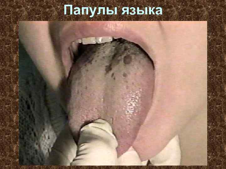 Папулы языка 