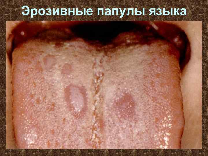 Эрозивные папулы языка 
