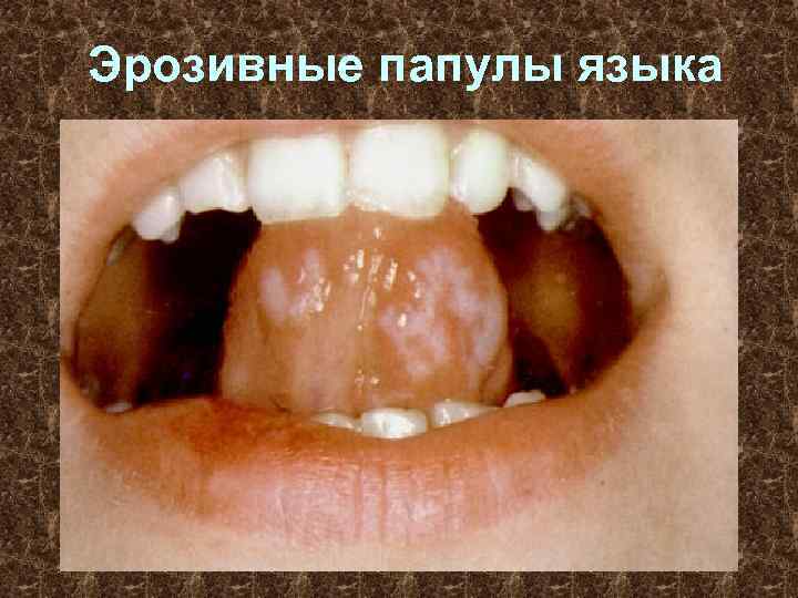 Эрозивные папулы языка 