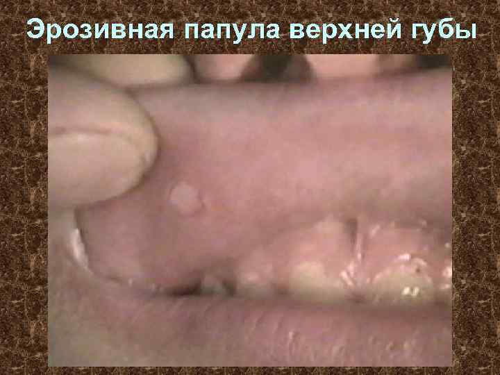 Эрозивная папула верхней губы 