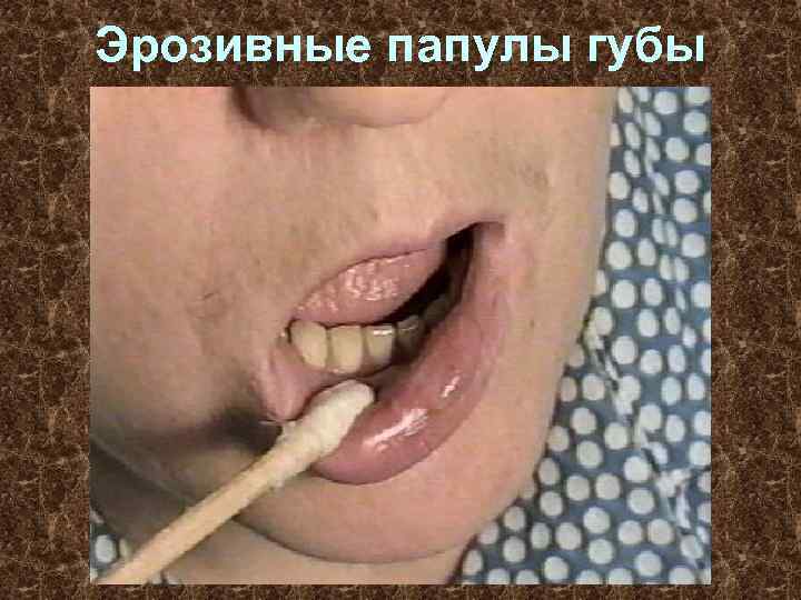 Эрозивные папулы губы 