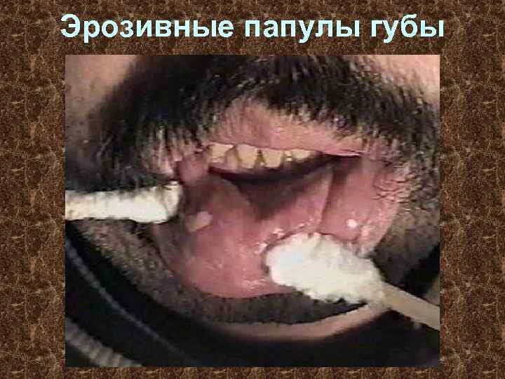 Эрозивные папулы губы 