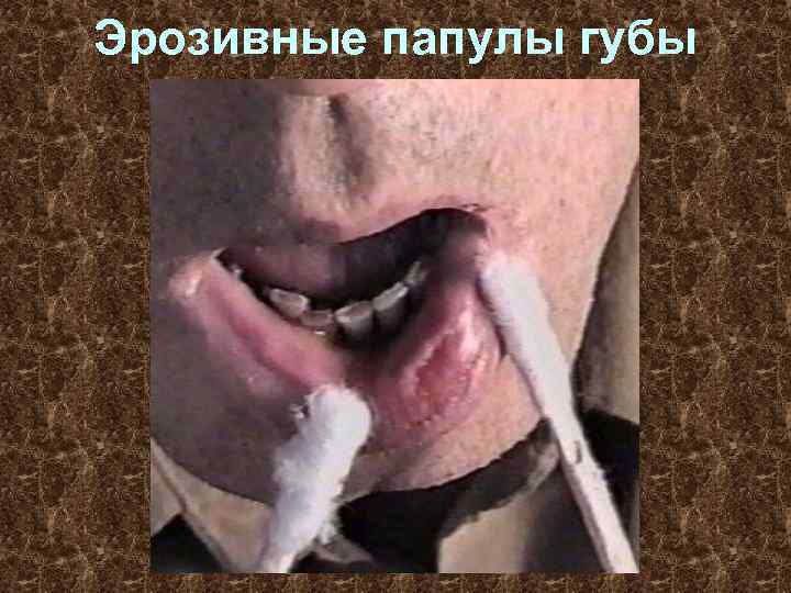 Эрозивные папулы губы 