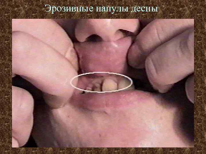 Эрозивные папулы десны 