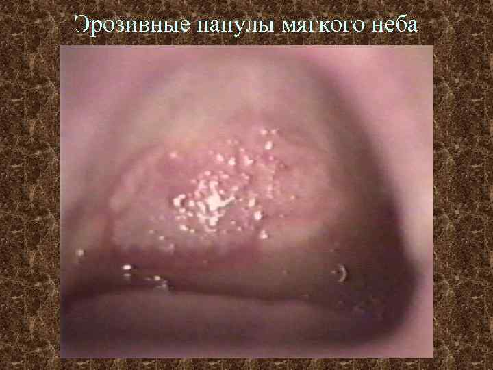 Эрозивные папулы мягкого неба 