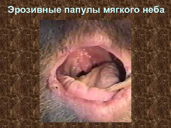 Эрозивные папулы мягкого неба 