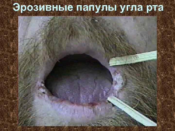 Эрозивные папулы угла рта 