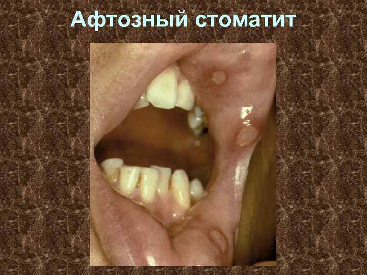 Афтозный стоматит 