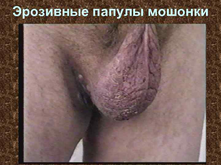 Эрозивные папулы мошонки 