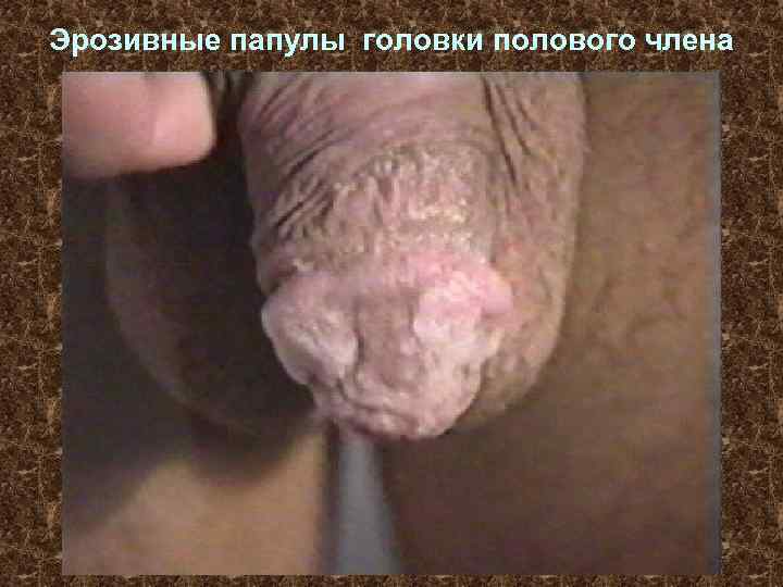 Эрозивные папулы головки полового члена 