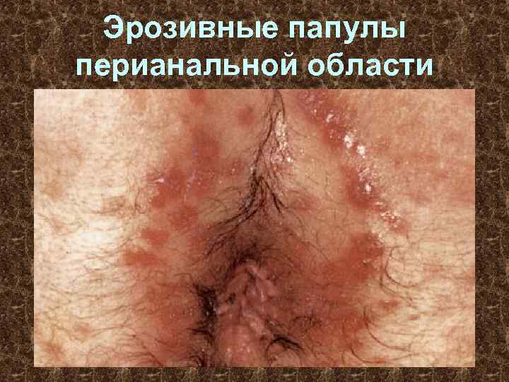 Эрозивные папулы перианальной области 