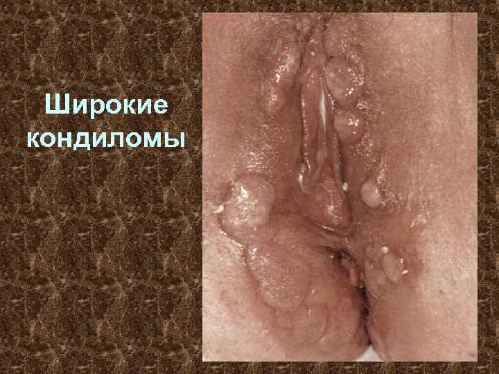 Широкие кондиломы 
