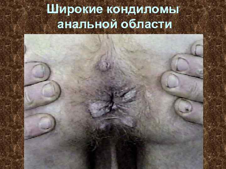 Широкие кондиломы анальной области 
