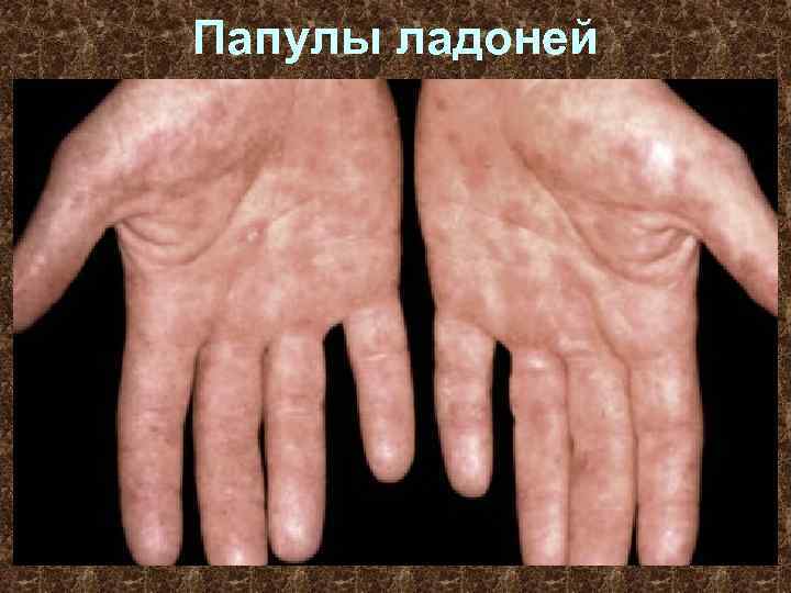 Папулы ладоней 