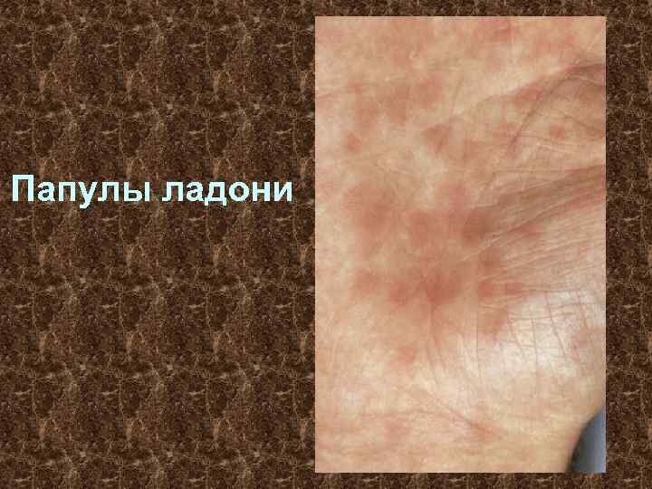 Папулы ладони 