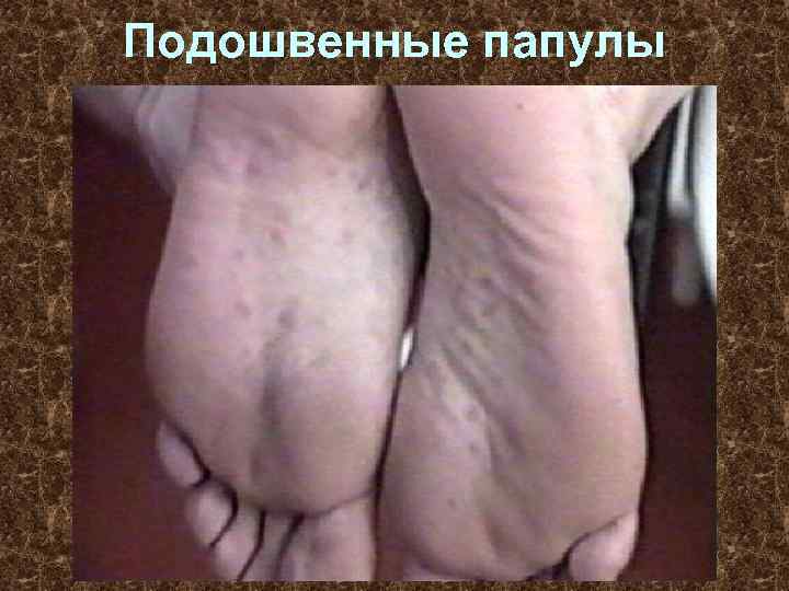 Подошвенные папулы 