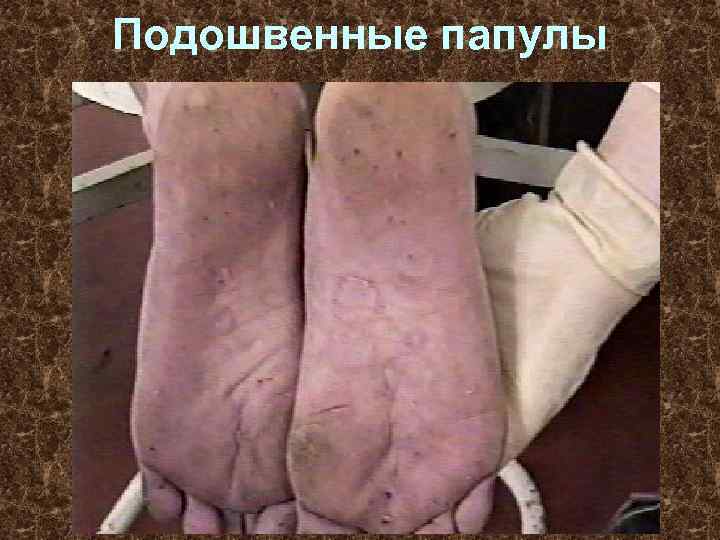 Подошвенные папулы 
