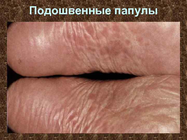Подошвенные папулы 