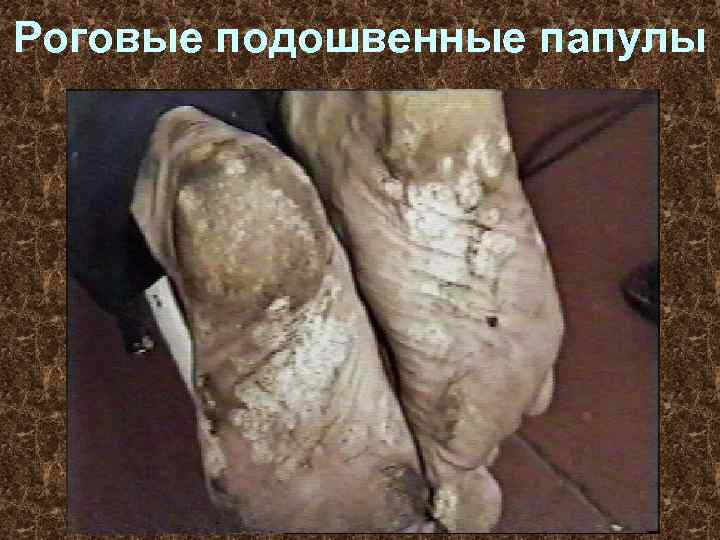 Роговые подошвенные папулы 