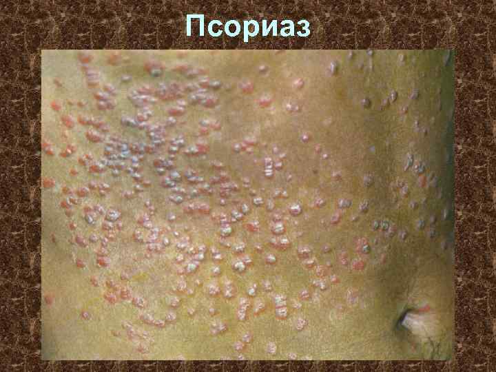 Псориаз 