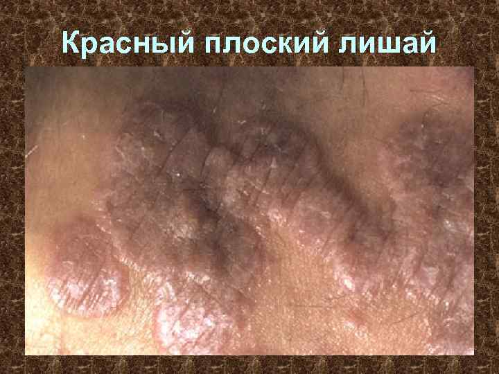 Красный плоский лишай 