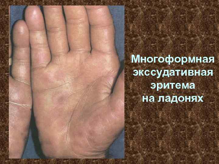 Многоформная экссудативная эритема на ладонях 