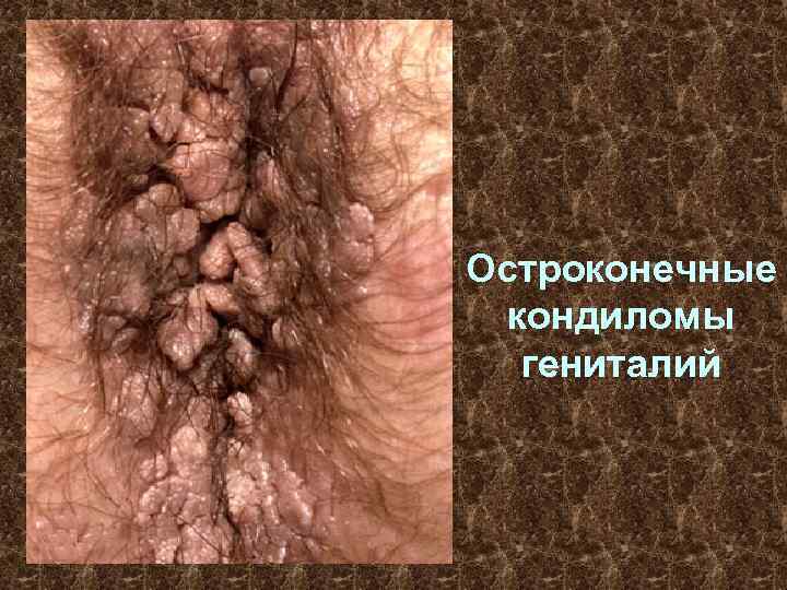 Остроконечные кондиломы гениталий 