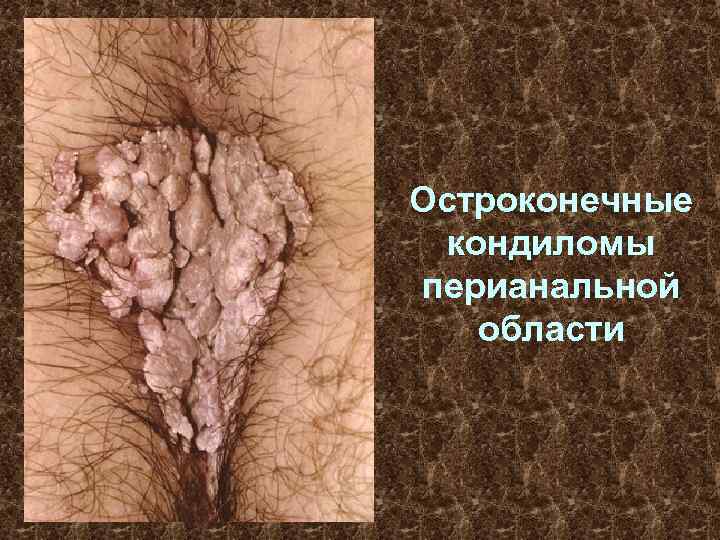 Остроконечные кондиломы перианальной области 