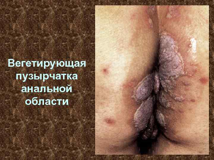 Вегетирующая пузырчатка анальной области 