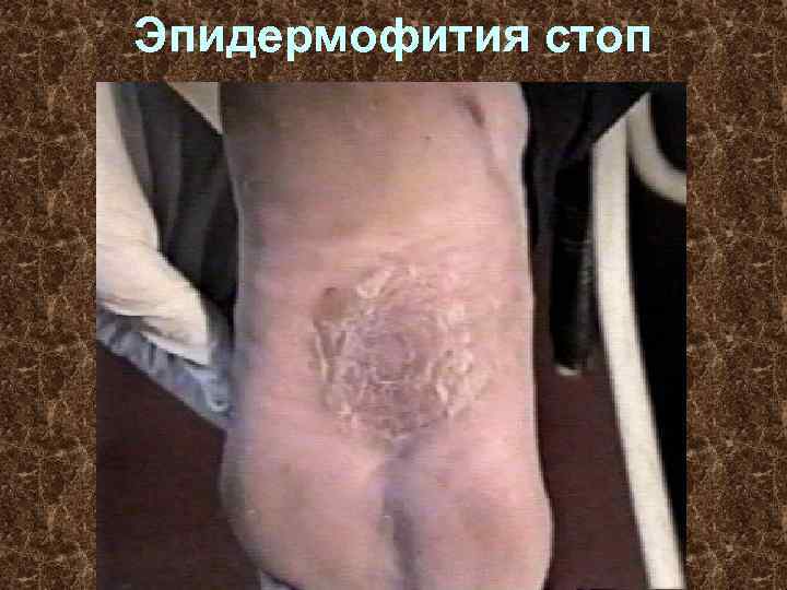 Эпидермофития стоп 