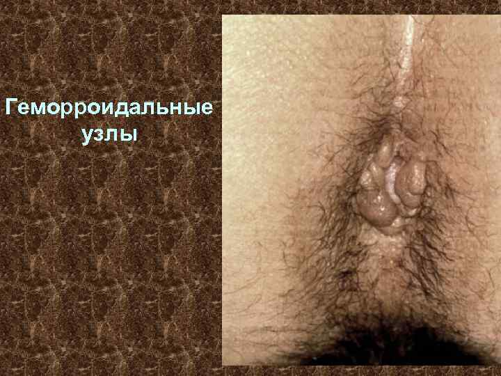 Геморроидальные узлы 